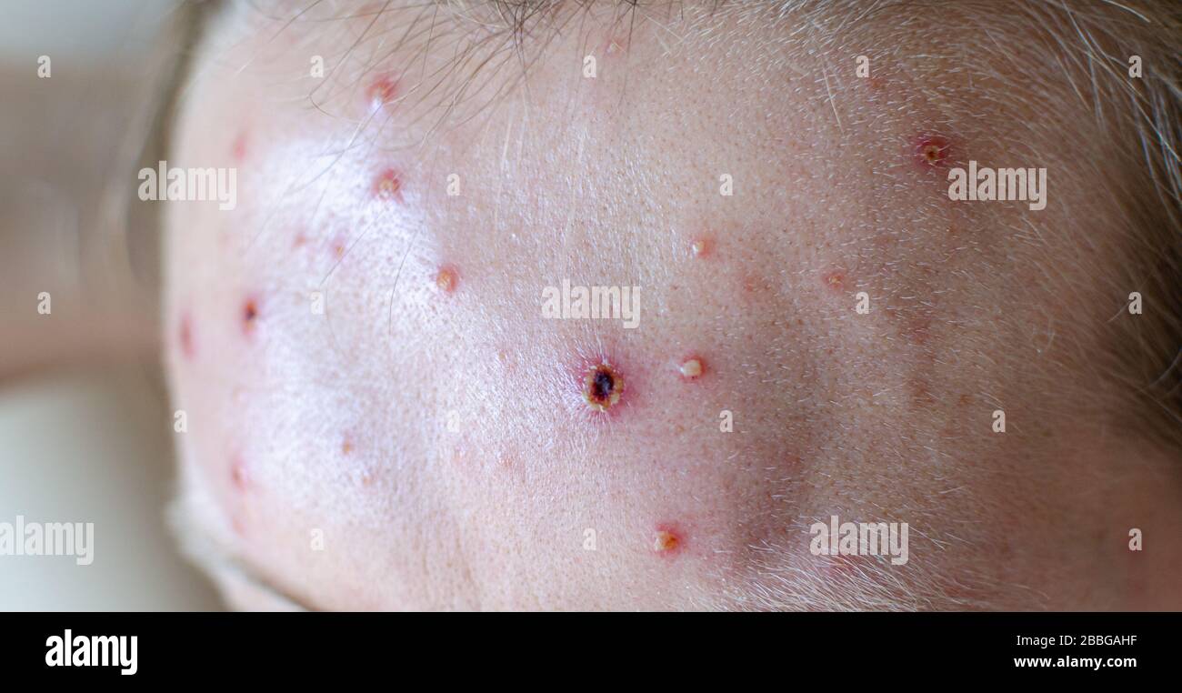 Große Flecken und Pickel Akne auf dem Körper - Erwachsener Körper mit Windpocken. Mann mit Chickenpocken, Varicella, Varicella-Zoster-Virus. Stockfoto