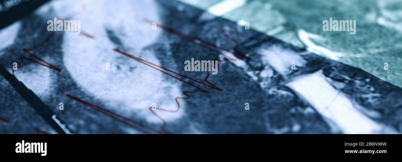 MRT-Bild über dem Kardiogrammdiagramm nah oben Stockfoto