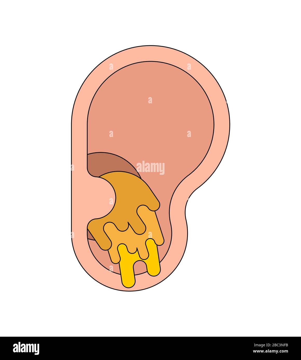 Ohrstöpsel Ohrenschmalz im Ohr isoliert. Cerumen-Vektor-Abbildung  Stock-Vektorgrafik - Alamy