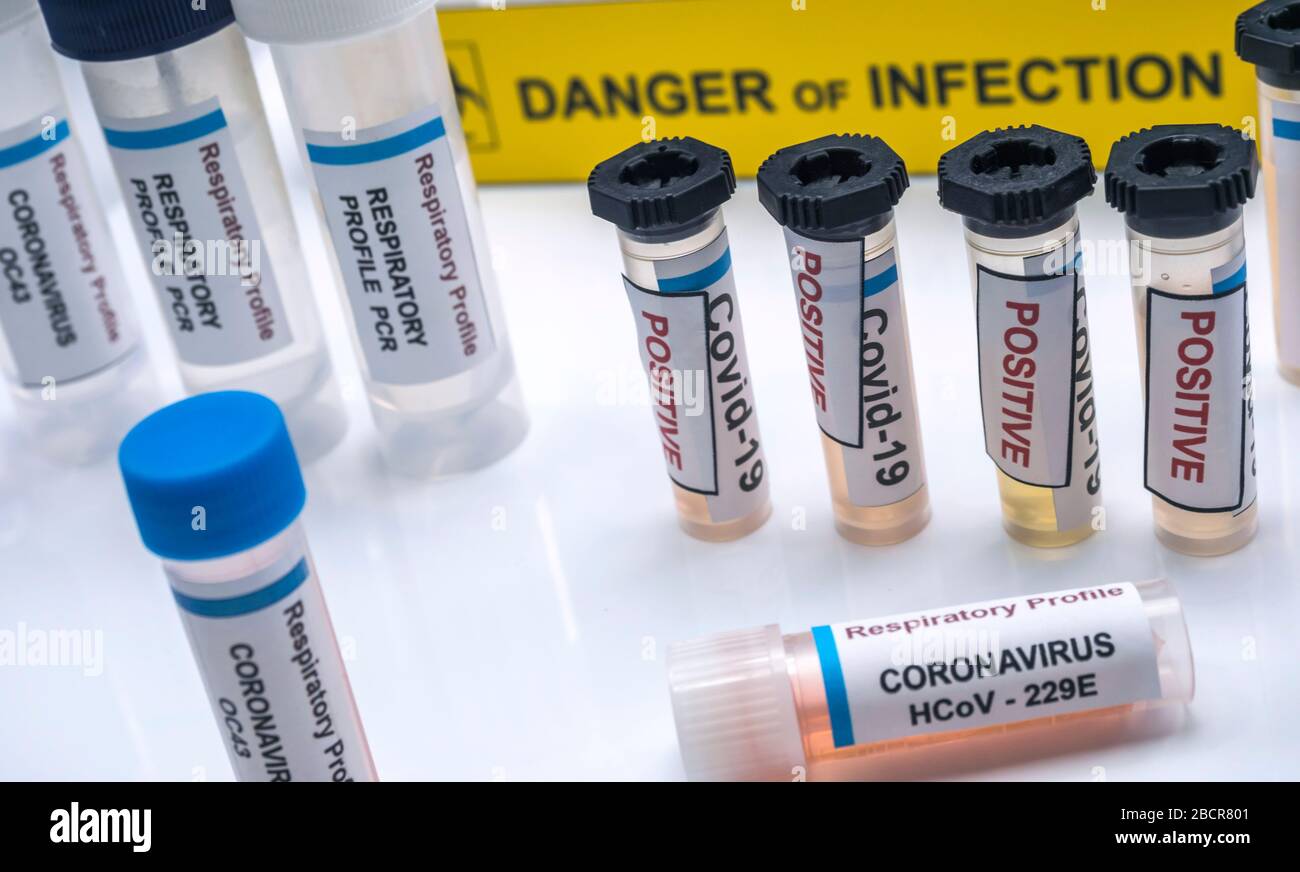 Probenflaschen mit positiven Ergebnissen von Patienten, die mit einem Kovid-19-Coronavirus in einem konzeptionellen Laborbild infiziert sind Stockfoto