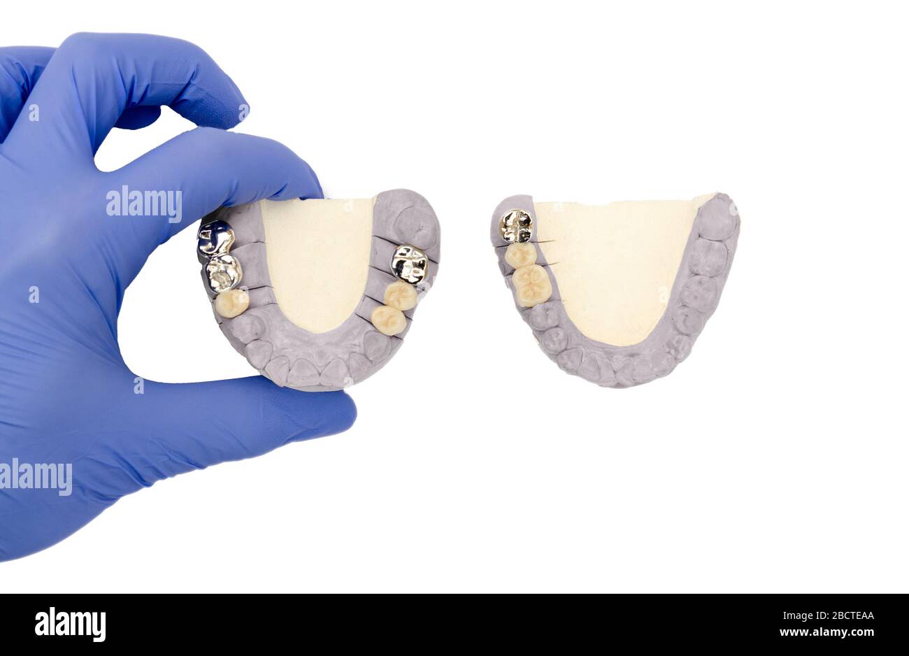 Zahnarzthand hält Zahnkronen. Keramik-Metall und Keramik Zahnbrücken. Isoliert. Zahnprothetik Konzept Stockfoto