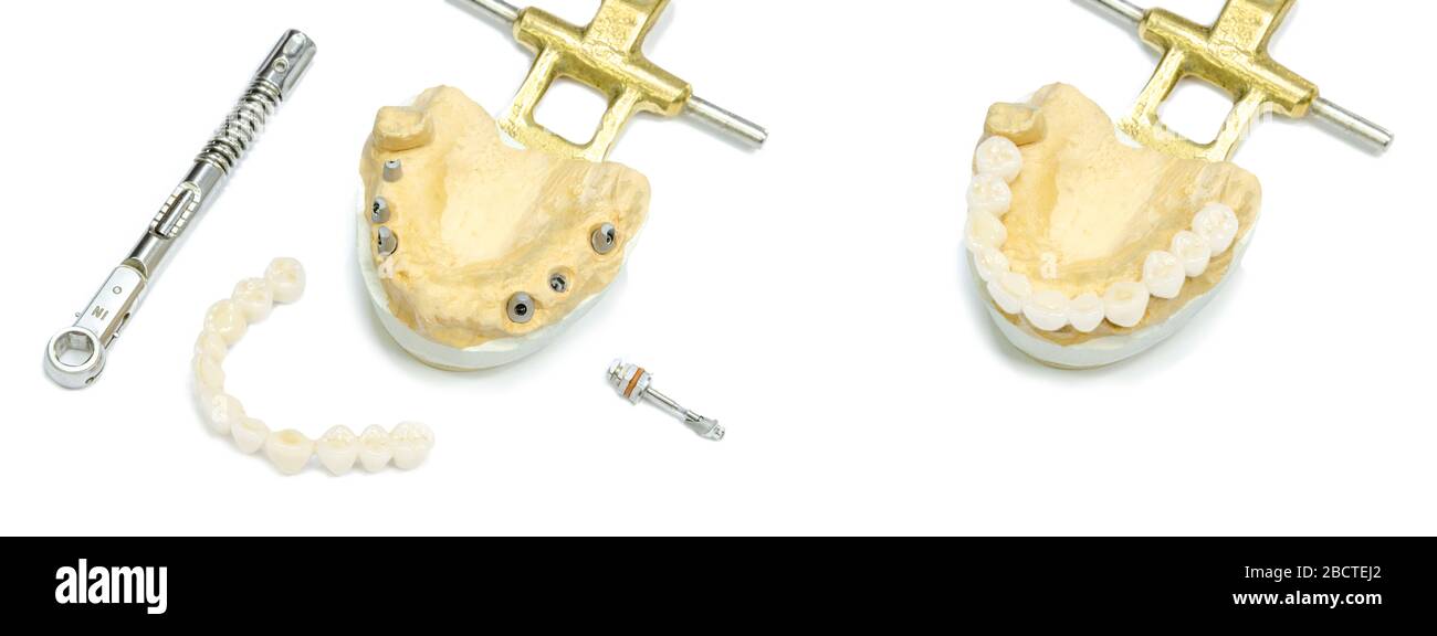 Weiße keramische Zähne mit Zahnimplantaten auf weißem Hintergrund. Drehmomentschlüssel und Schraubendreher. Konzept der dentalen Implantation und orthopädische de Stockfoto