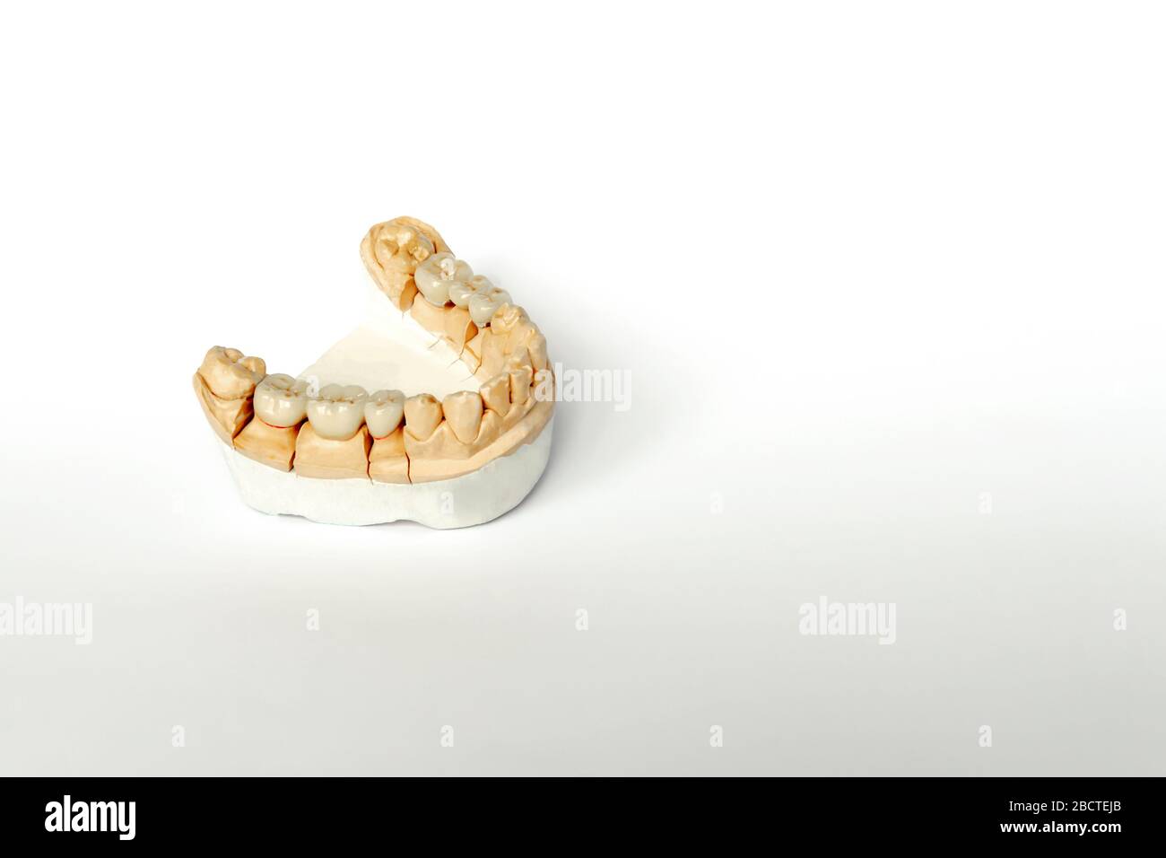 Orthopädische Zahnheilkunde. Zahnersatz Konzept. Zahnprothetik. Cermet Zähne. Keramik Brücken. Gips Modell des Kiefers und Zähne. Weißer Hintergrund Stockfoto