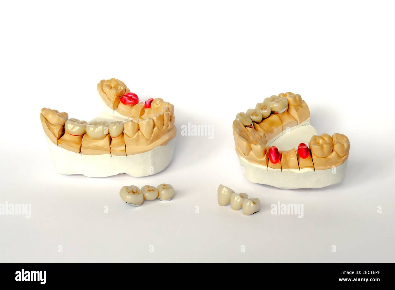 Konzept der orthopädischen Zahnmedizin. Zahnprothetik mit keramischen Kronen und Brücken. Zahnbrücken auf den hinteren Zähnen. Ästhetische Prothetik. gyp Stockfoto