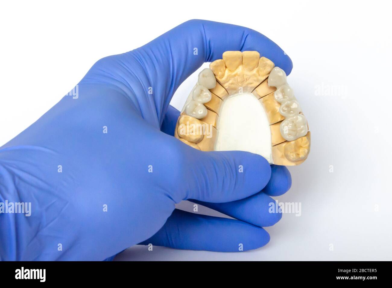 Zahnersatz. Keramikzähne. Zahnbrücken. Orthopädische Zahnheilkunde. Cermet-Brücken sind auf dem Gipsmodell nach der Herstellung. Gipsmodell mit Zähnen Stockfoto
