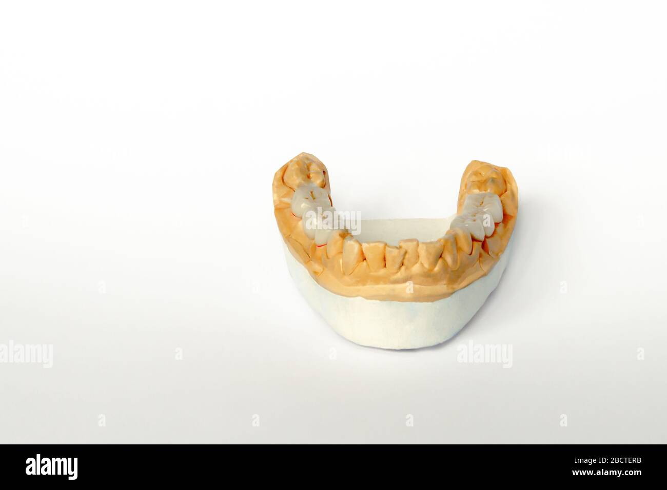 Falsche Zähne. Brücke-Keramik-Metall-Prothesen. Keramikzahnprothesen auf dem Gipsmodell des Unterkiefers Stockfoto