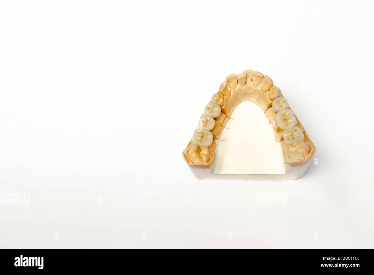 Gipsmodell der Zähne des Unterkiefers mit keramischen Zähnen. Falsche Zähne Molaren und Prämolaren. Weißer Hintergrund Stockfoto