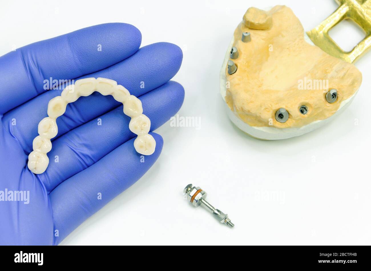 Künstliche Zähne in der Hand des Zahnarztes. Keramik Zahnbrücke für Prothetik auf Zahnimplantaten. Abverschraubte Zahnabutment und Modell mit Zahnimpl Stockfoto