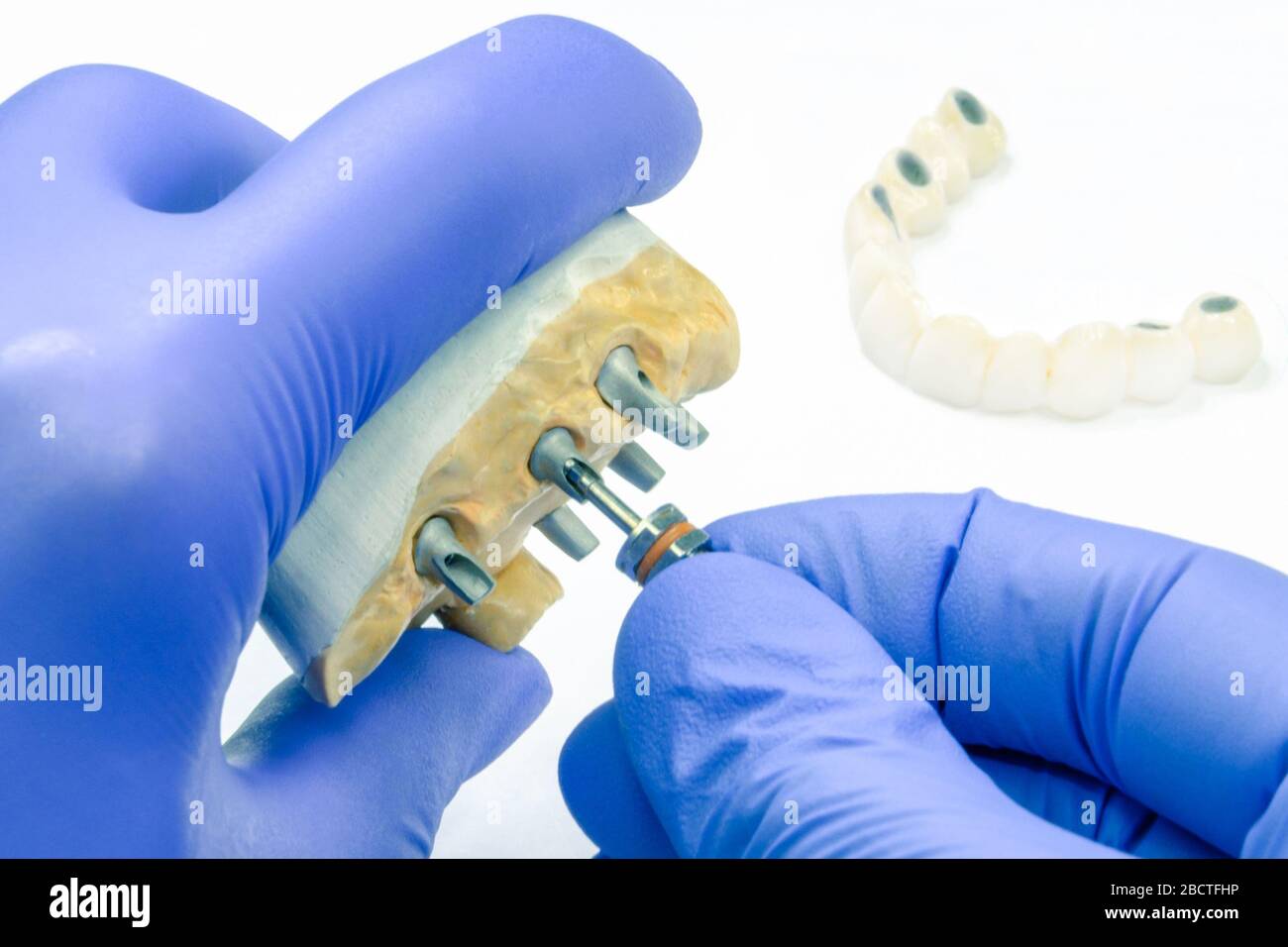 Der Zahnarzt spinnt das Zahnimplantat. Das Konzept der Prothetik auf Zahnimplantaten und die Herstellung von keramischen künstlichen Zähnen auf Implantaten Stockfoto