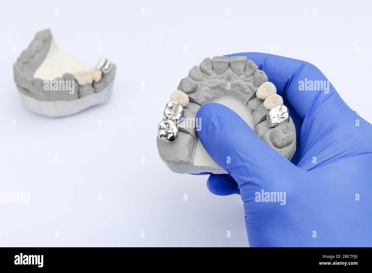 Zahnfälschung. Kronen und Brücken aus Metall und Keramik. Die Hand des Zahnarztes hält ein Gipsmodell. Konzept der orthopädischen Zahnheilkunde Stockfoto