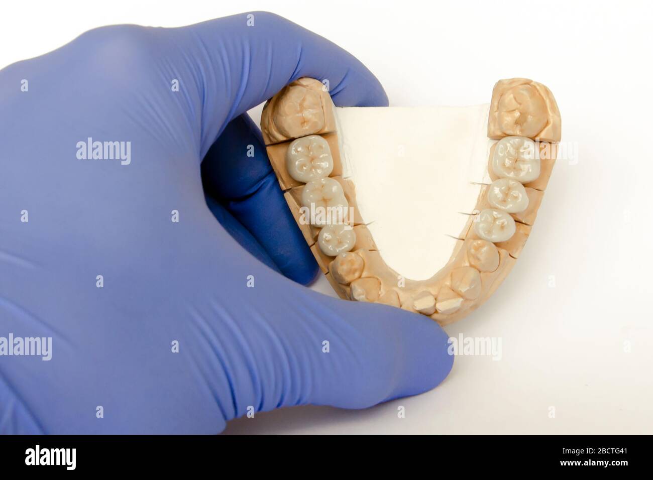 Keramik-Metall-Brücken auf einem Gipsmodell in den Händen eines Zahnarztes. Keramik-Kronen, Brücken, Implantate Stockfoto