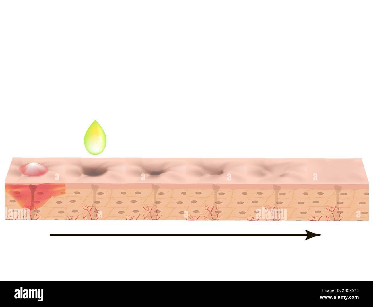 Atrophische Narben. Akne Narbe. Die anatomische Struktur der Haut mit Akne. Vector Illustration auf isolierte Hintergrund. Stock Vektor