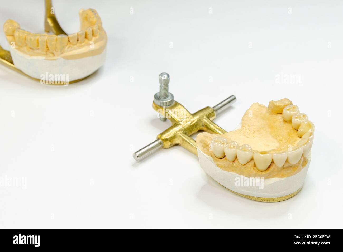 Keramikbrücke zum Oberkiefer auf Implantaten. Konzept der orthopädischen Zahnheilkunde. Dentale Prothetik Hintergrund Stockfoto