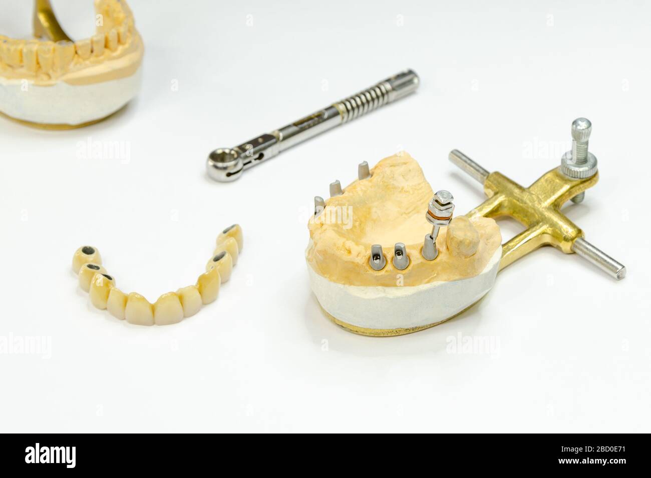 Künstliche Zähne auf Implantaten. Kiefermodell mit Zahnimplantaten. Ein Schraubendreher wird in den Abutment eingeführt. Der Schlüssel ist als nächstes Stockfoto