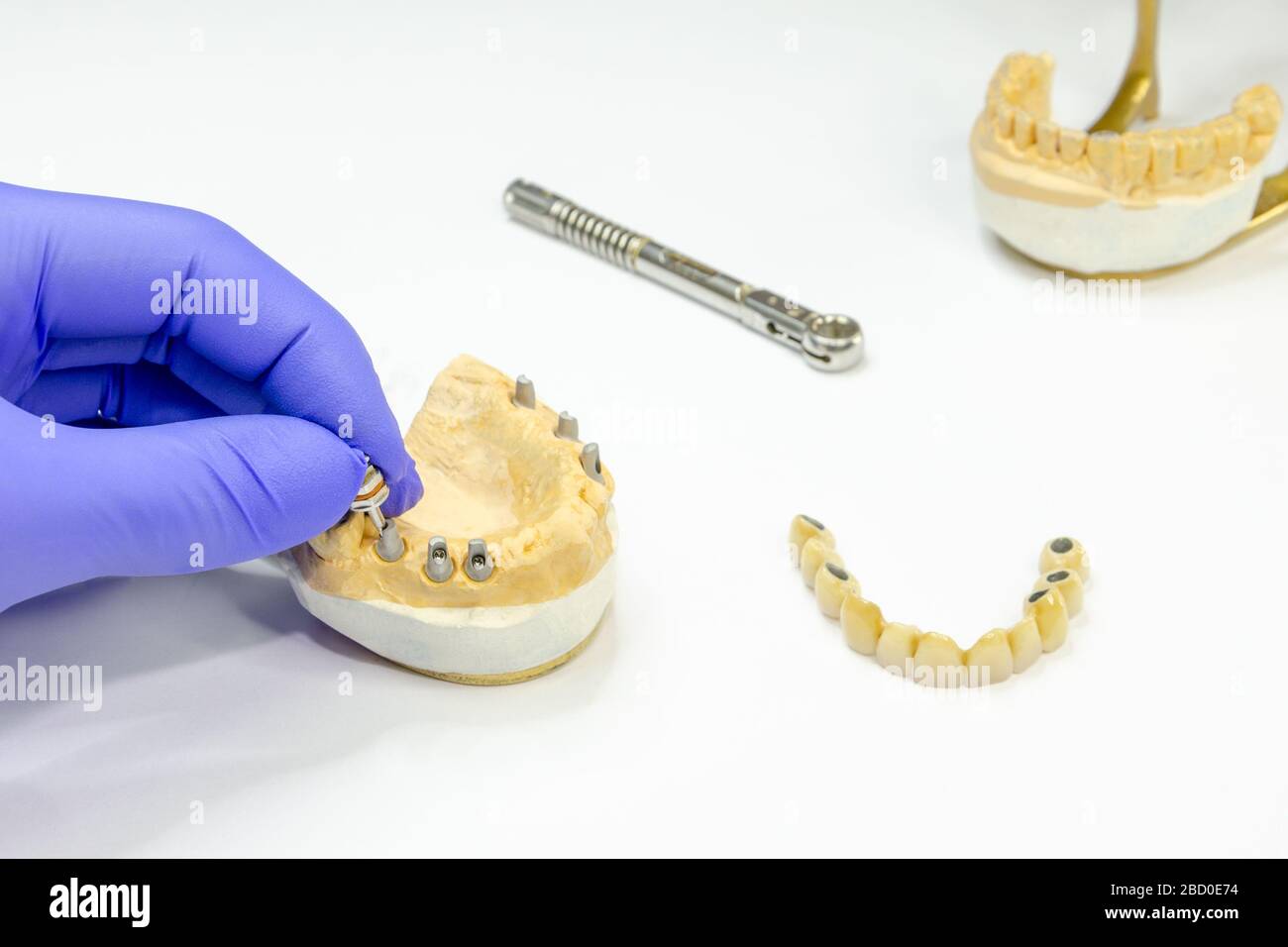 Herstellung eines festen Zahnprotheses auf Implantaten. Keramikbrücke auf Implantaten. Zahnarzthand entschraubt Abutment Stockfoto
