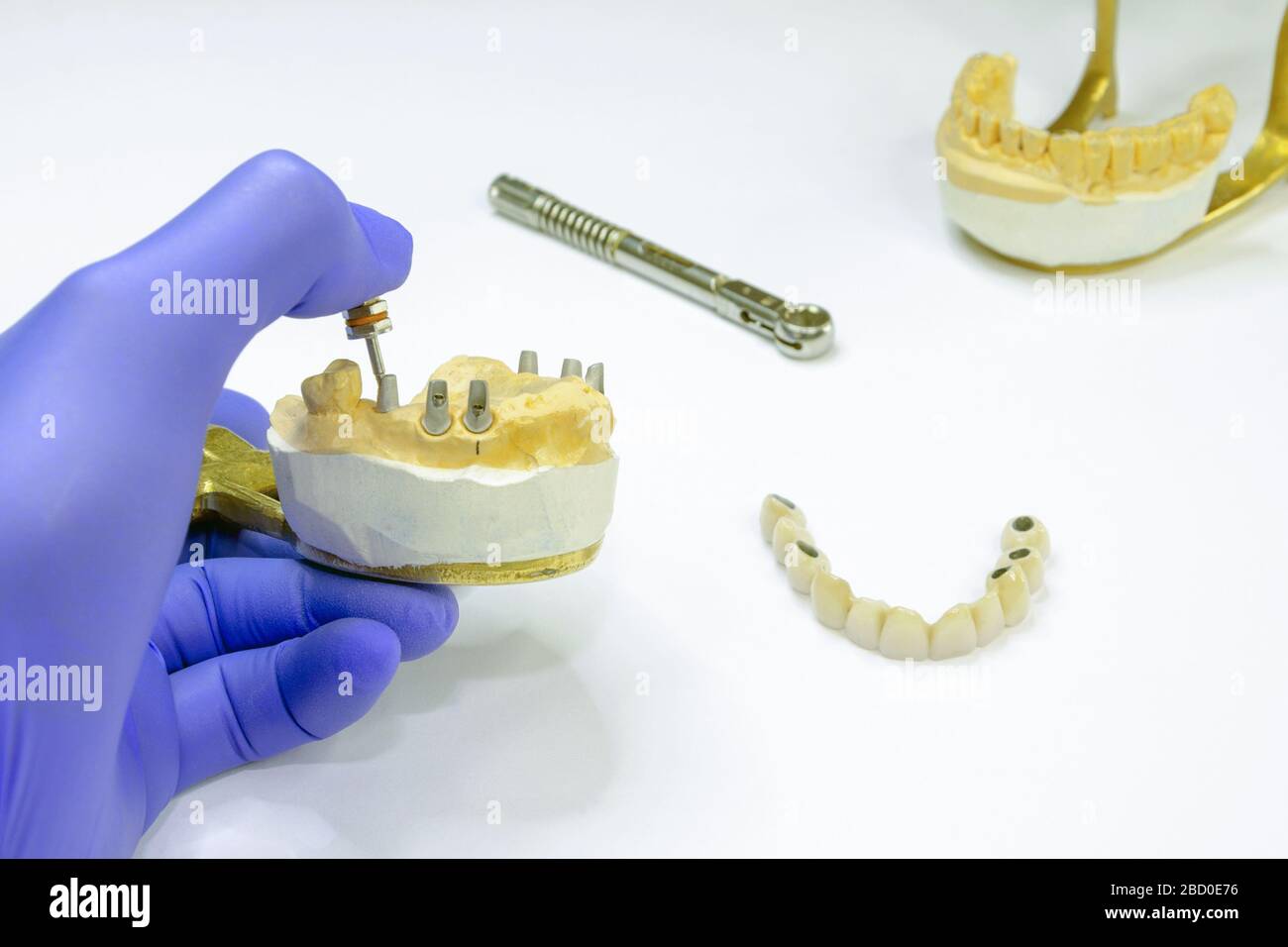 zahntechnik auf Zahnimplantaten. Konzept der orthopädischen Zahnheilkunde. Keramik Brücke auf Implantaten. Zahnarzt Hand hält einen Gipskiefer mit Zahnabutments Stockfoto