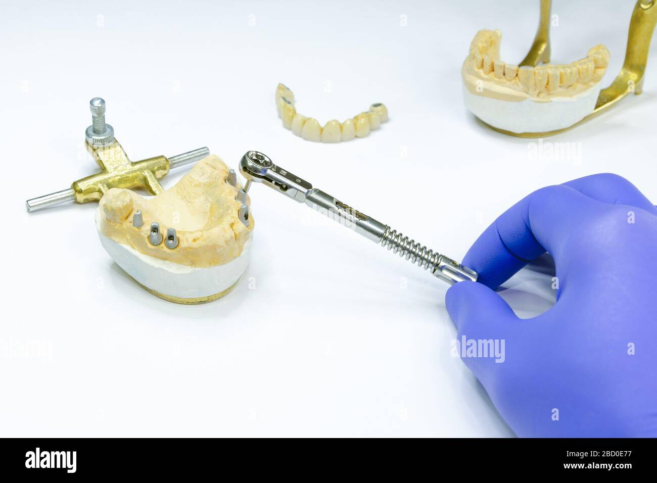 Der Zahnarzt entschraubt das Implantat mit einem Schlüssel. Implantatprothetik. Herstellung von Kronen auf Implantaten. Zahnimplantation Stockfoto