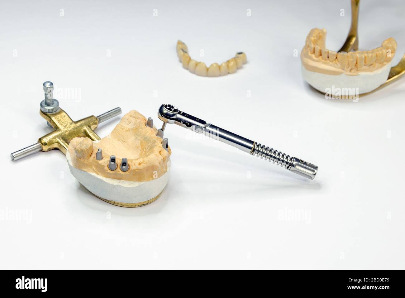 Zahnimplantation. Dentale Implantate Hintergrund. Dentale Implantat Konzept. Der Schlüssel entschrauben das Zahnimplantat. Licht Hintergrund Stockfoto