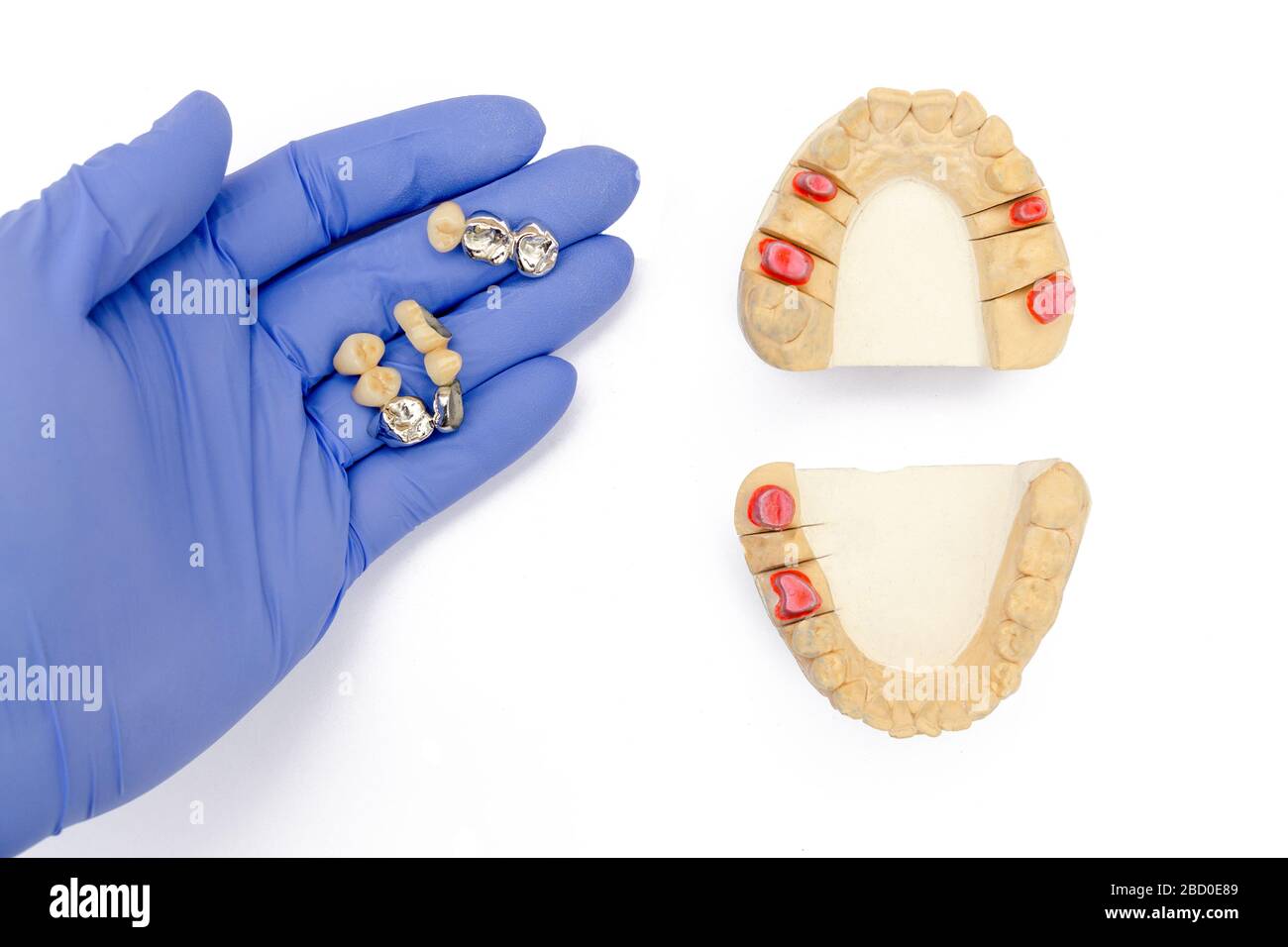 Zahnprothetik Hintergrund. Gefälschte Zähne Konzept. Kronen und Brücken sind in der Hand des Zahnarztes. Gipsmodelle der oberen und unteren Kiefer Stockfoto