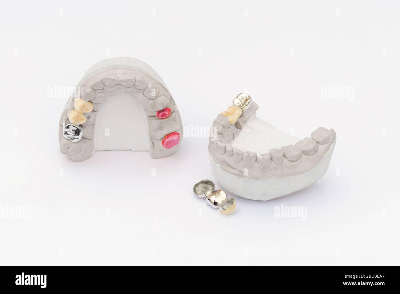 Zahnkronen isoliert auf weißem Hintergrund. Orthopädische Zahnheilkunde Hintergrund. Keramik-Metall-Zahnbrücken und Kronen Stockfoto