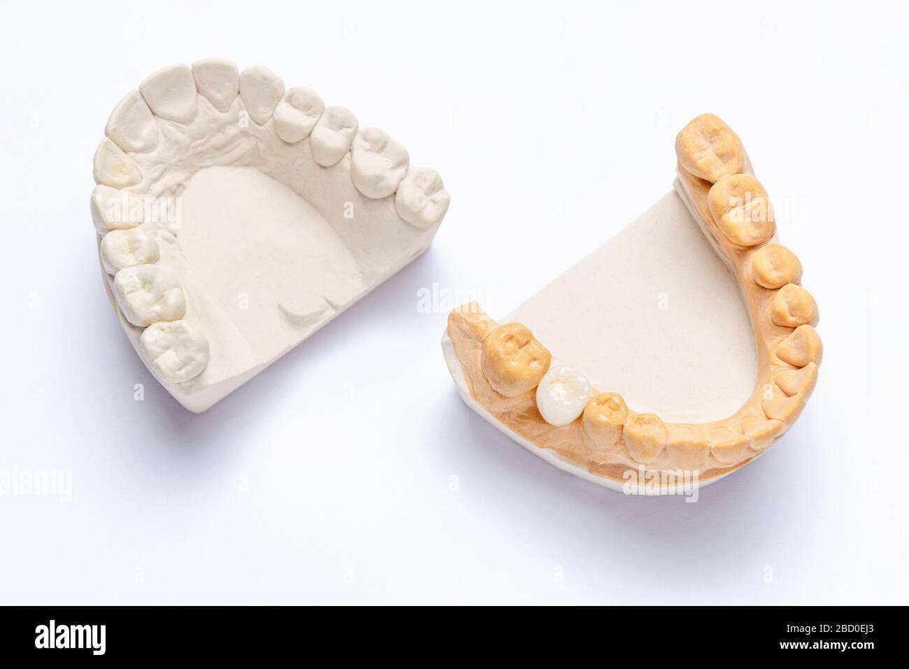 Auf weißem Hintergrund sind Putz-Modelle der Kiefer mit einer Keramikkrone auf einem Molar. Weißer künstlicher Zahn auf dem Implantat. Konzept der Orthopäden Stockfoto