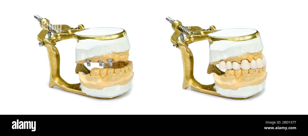 Kiefer Modelle mit Zahnimplantaten und orthopädischen Implantatbau. Implantat Prothetik Konzept. Orthopädische Zahnheilkunde. Isoliert auf einem weißen Hintergrund Stockfoto