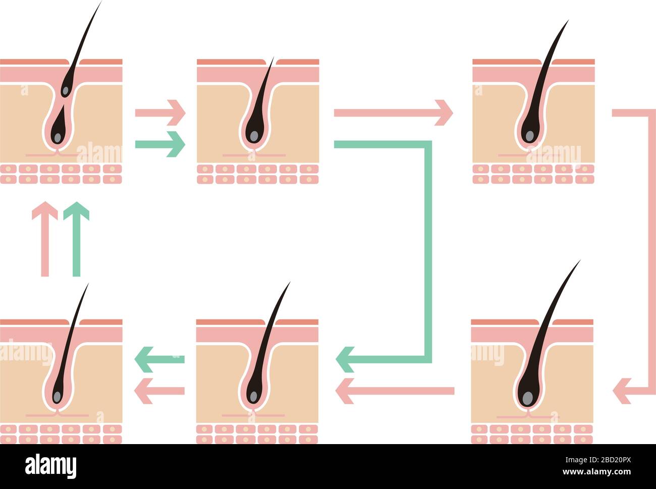 Vergleichende Darstellung des normalen Haarzyklus und der AGA (androgenetische Alopezie) Stock Vektor