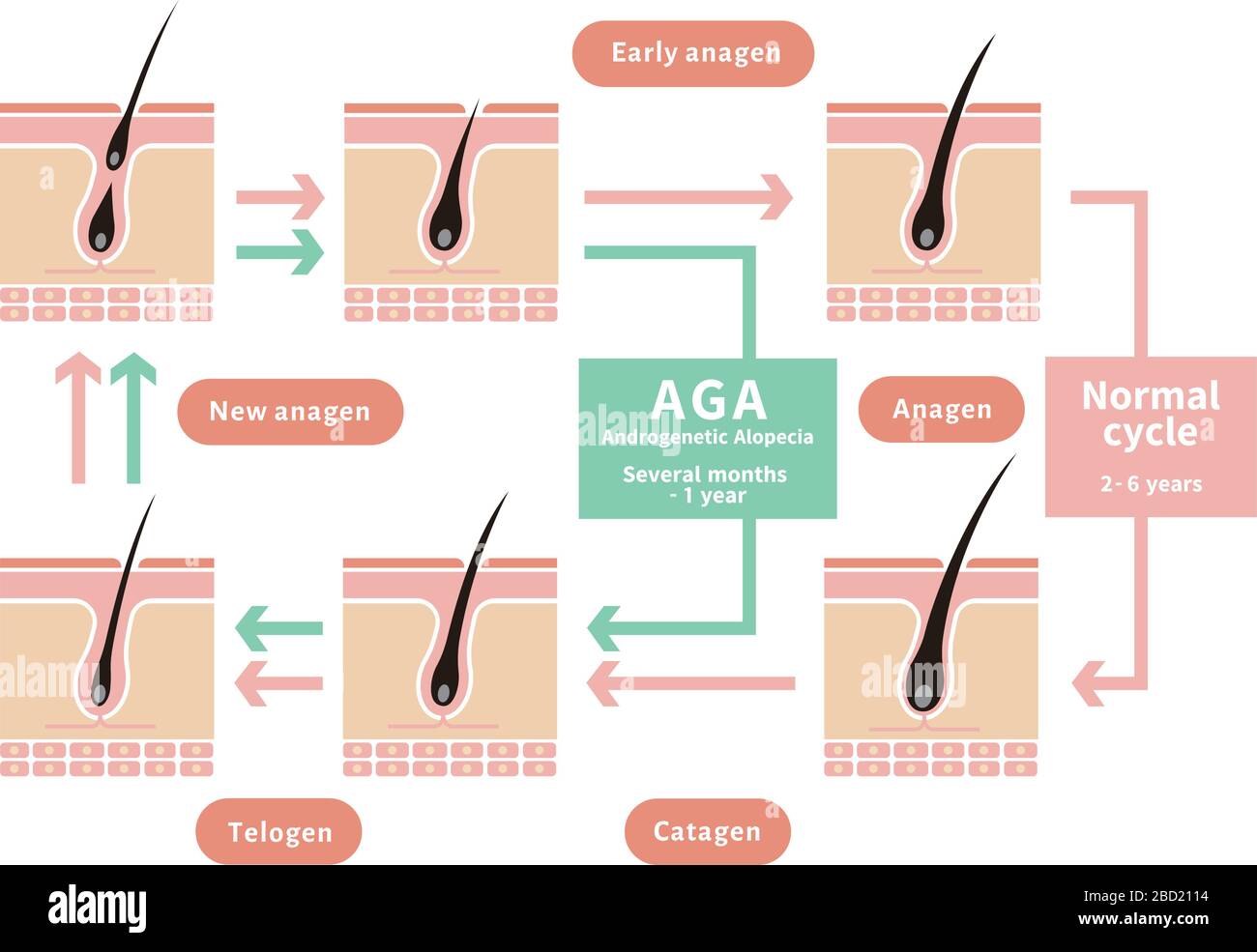 Vergleichende Darstellung des normalen Haarzyklus und der AGA (androgenetische Alopezie) Stock Vektor
