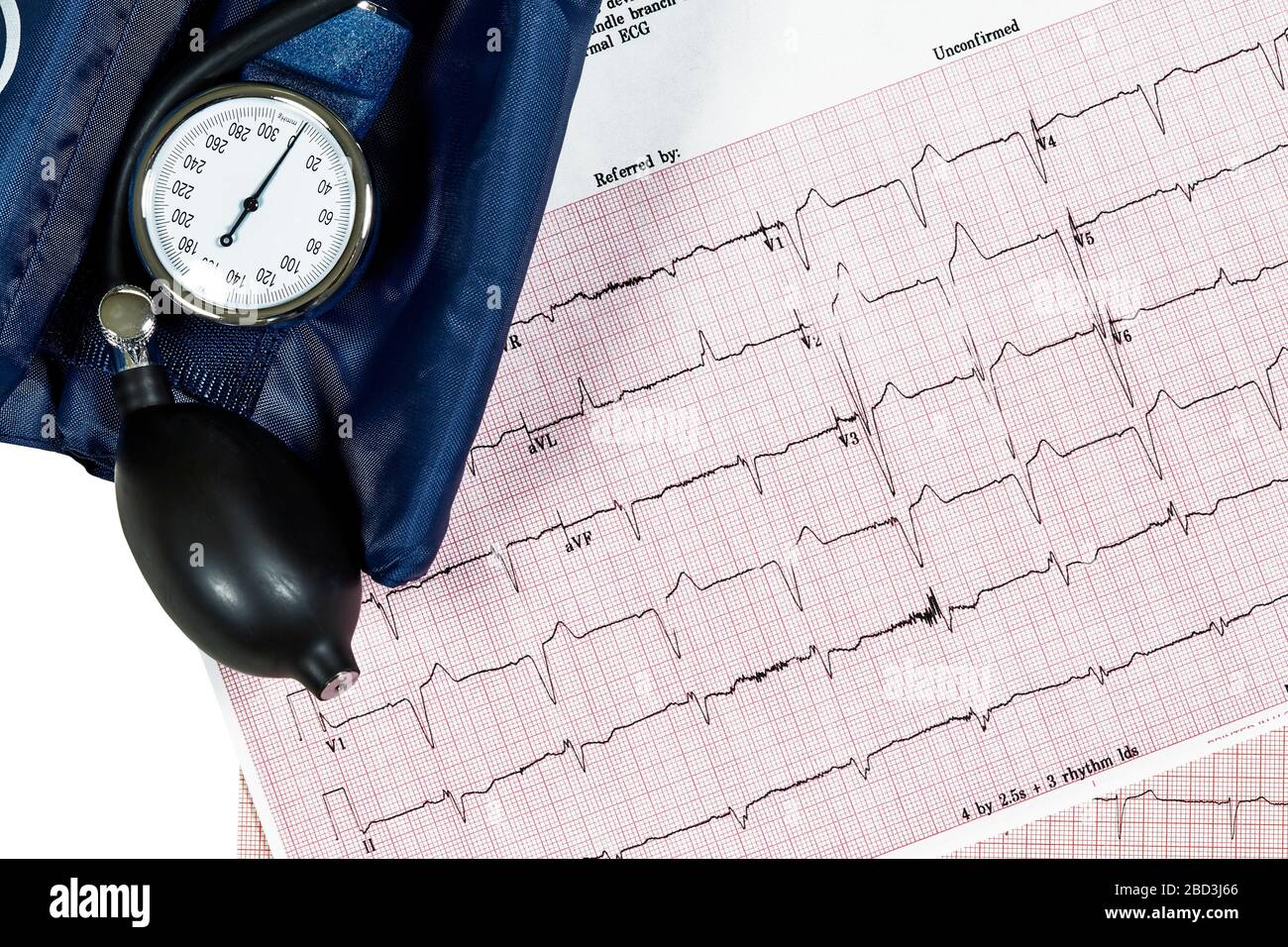 Nahaufnahme von zwei verschiedenen EKG-Testberichten (Ecocardiography Test Reports), die einen abnormalen Herzrhythmus und eine Blutdruckmanschette zeigen Stockfoto