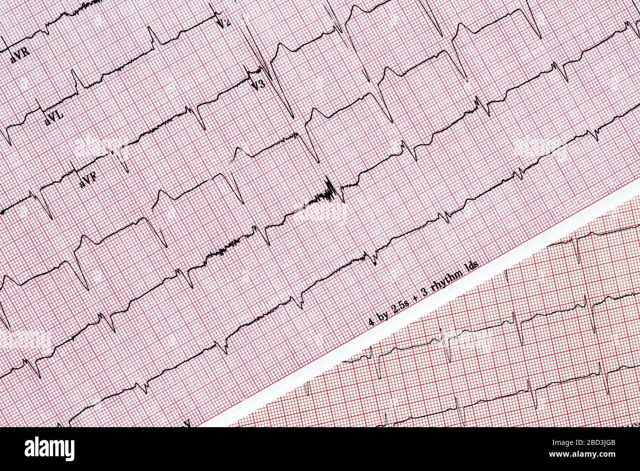 Nahaufnahme von zwei verschiedenen EKG-Testberichten (Ecocardiography Test Reports), die einen abnormalen Herzrhythmus zeigen Stockfoto