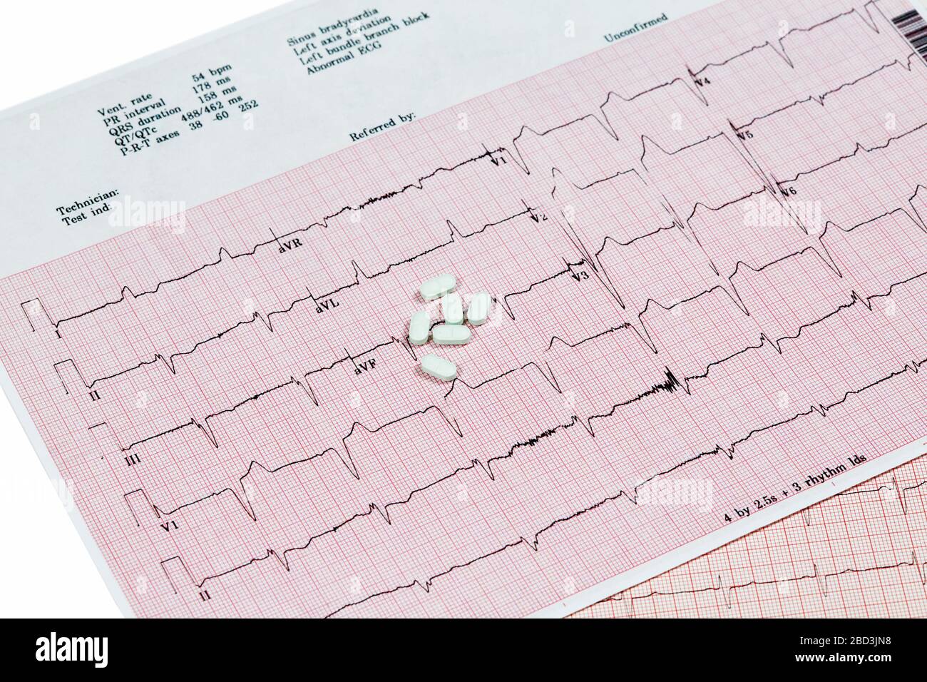 Nahaufnahme des Echokardiographen-Testberichts (EKG), der einen abnormalen Herzrhythmus mit Medikamenten anzeigt Stockfoto