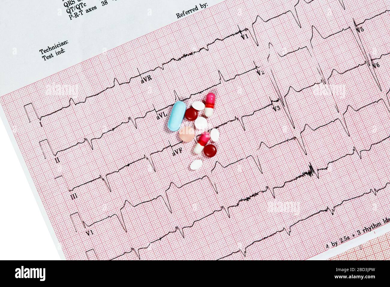 Nahaufnahme des Echokardiographen-Testberichts (EKG), der einen abnormalen Herzrhythmus mit Medikamenten anzeigt Stockfoto