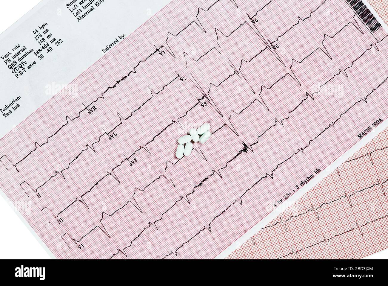 Nahaufnahme des Echokardiographen-Testberichts (EKG), der einen abnormalen Herzrhythmus mit Medikamenten anzeigt Stockfoto