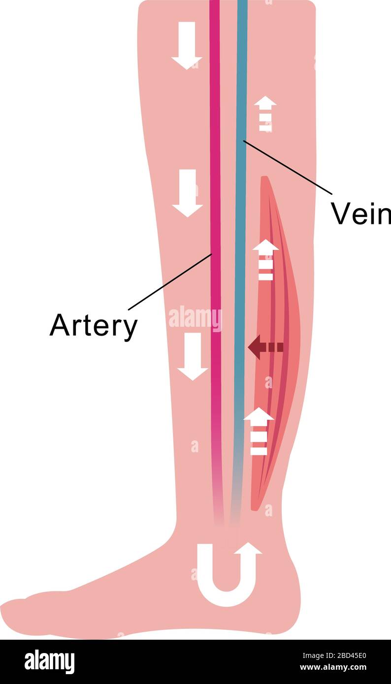 Ursache für Schwellungen (Ödem) der Beine. Verminderte Durchblutung durch Muskelschwäche. Flache Abbildung. Stock Vektor