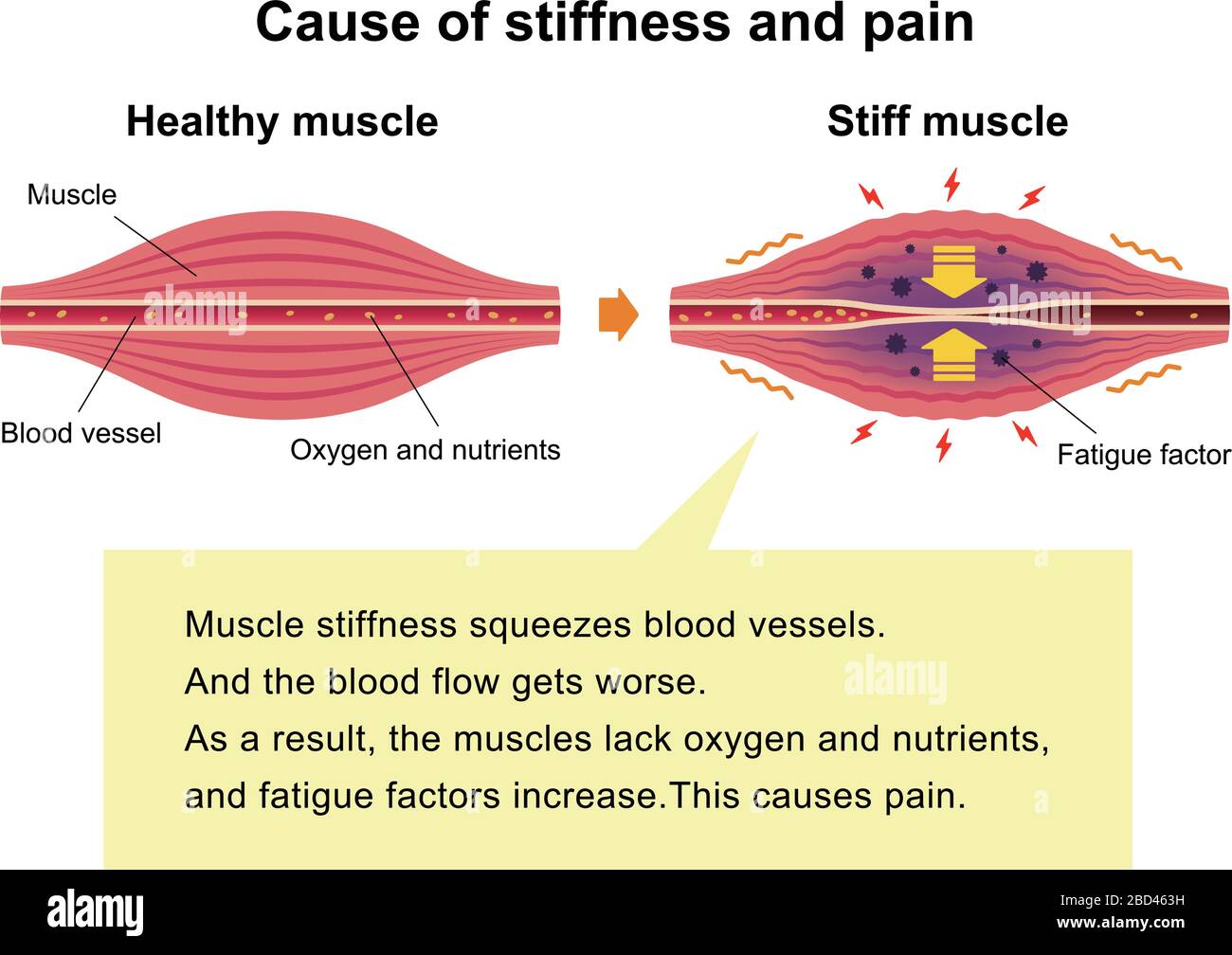 Illustration der Ursache für Muskelsteifigkeit und -Schmerzen Stock Vektor