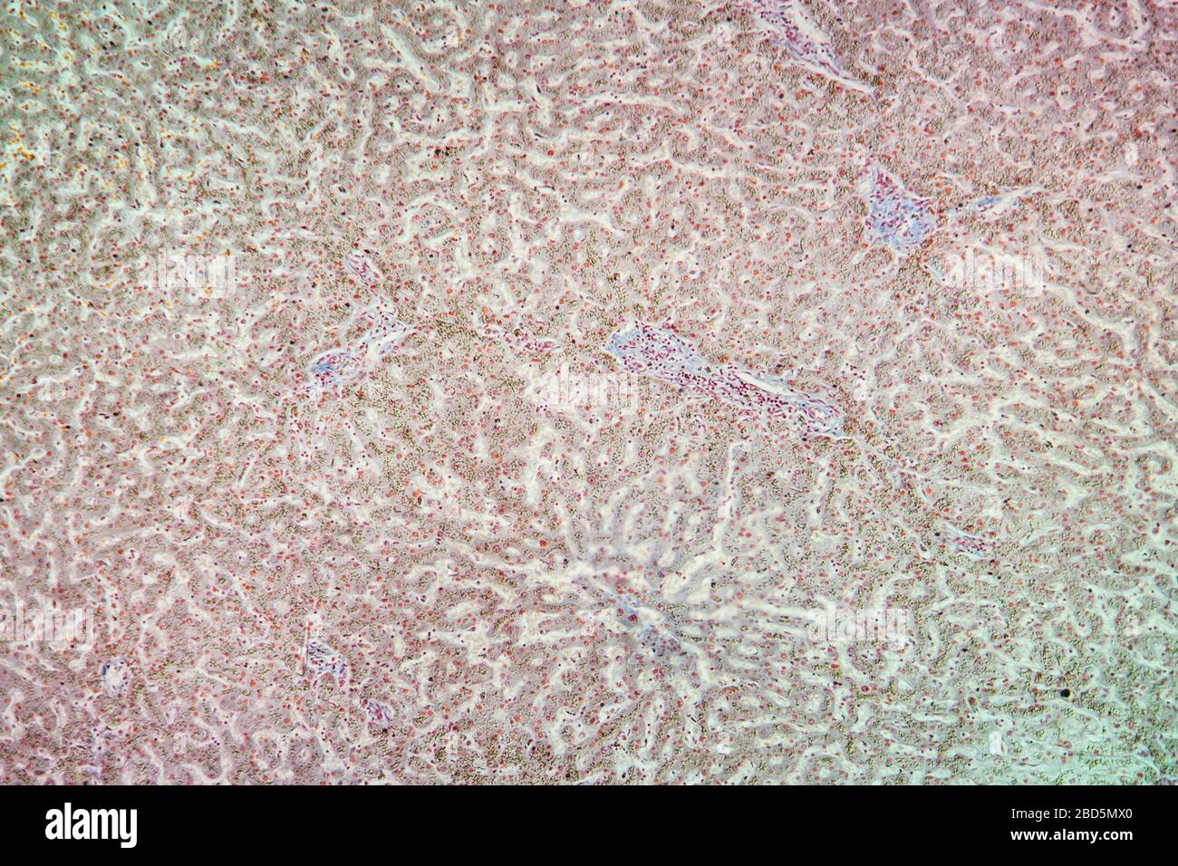 Hemosiderosis Gewebe unter dem Mikroskop 100x Stockfoto
