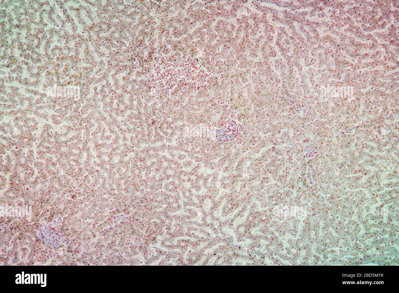 Hemosiderosis Gewebe unter dem Mikroskop 100x Stockfoto