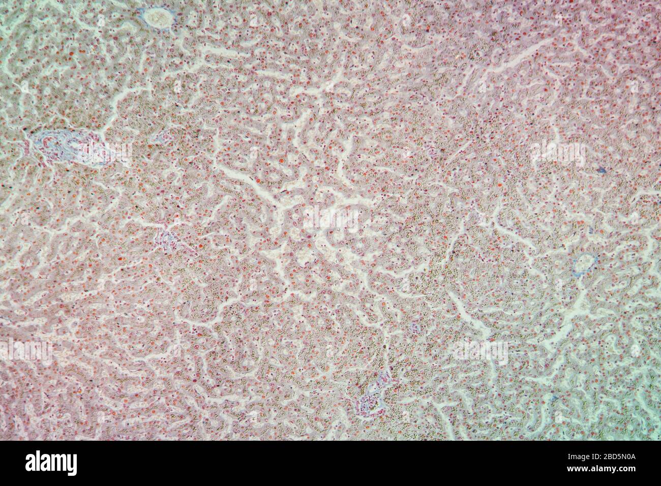 Hemosiderosis Gewebe unter dem Mikroskop 100x Stockfoto