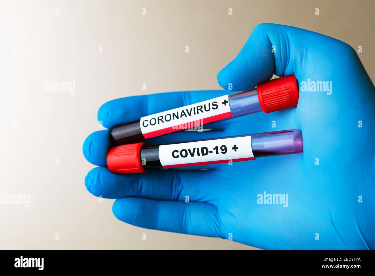 Hand-in-Handschuh hält das Röhrchen mit einer positiven Blutprobe für die COVID-19 Stockfoto