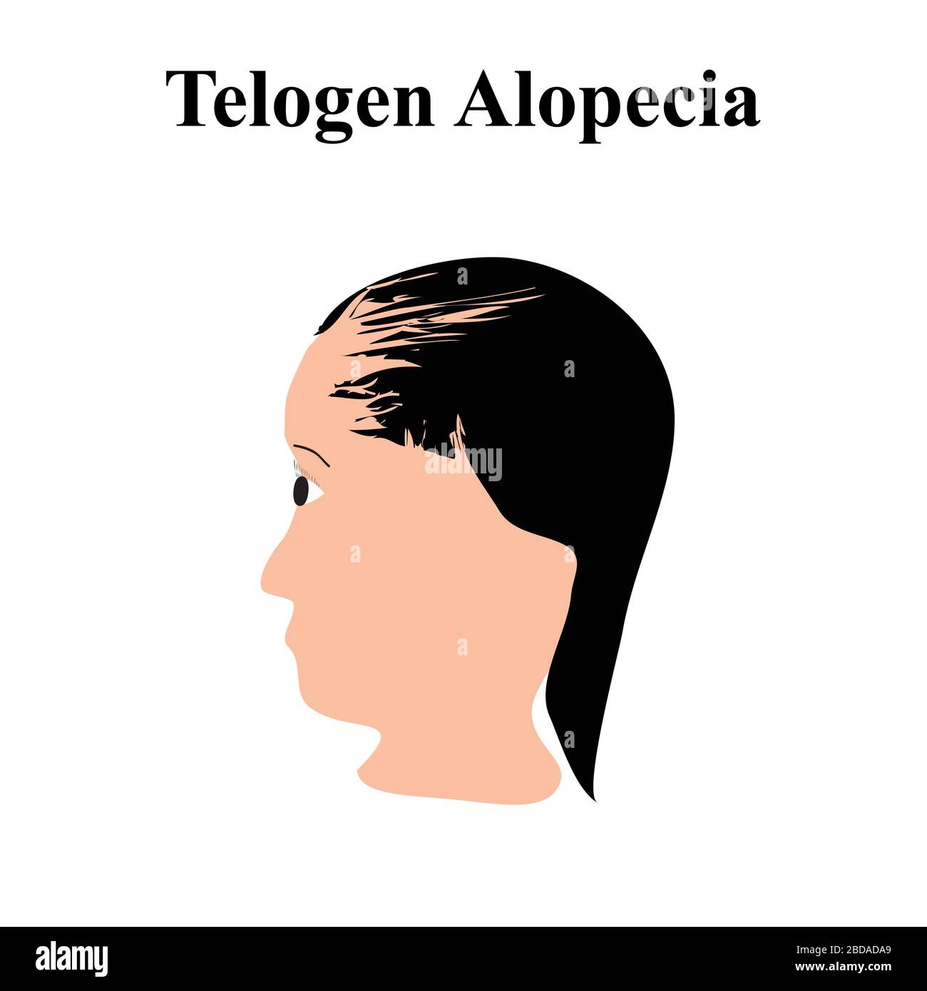 Alopezie Haar. Haarausfall am Kopf. Telogen Alopecia. Infografiken. Vektordarstellung auf isoliertem Hintergrund. Stock Vektor
