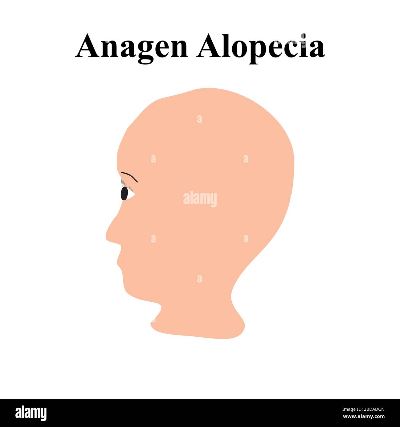 Alopezie Haar. Haarausfall am Kopf. Alagen Alopecia. Infografiken. Vektordarstellung auf isoliertem Hintergrund. Stock Vektor