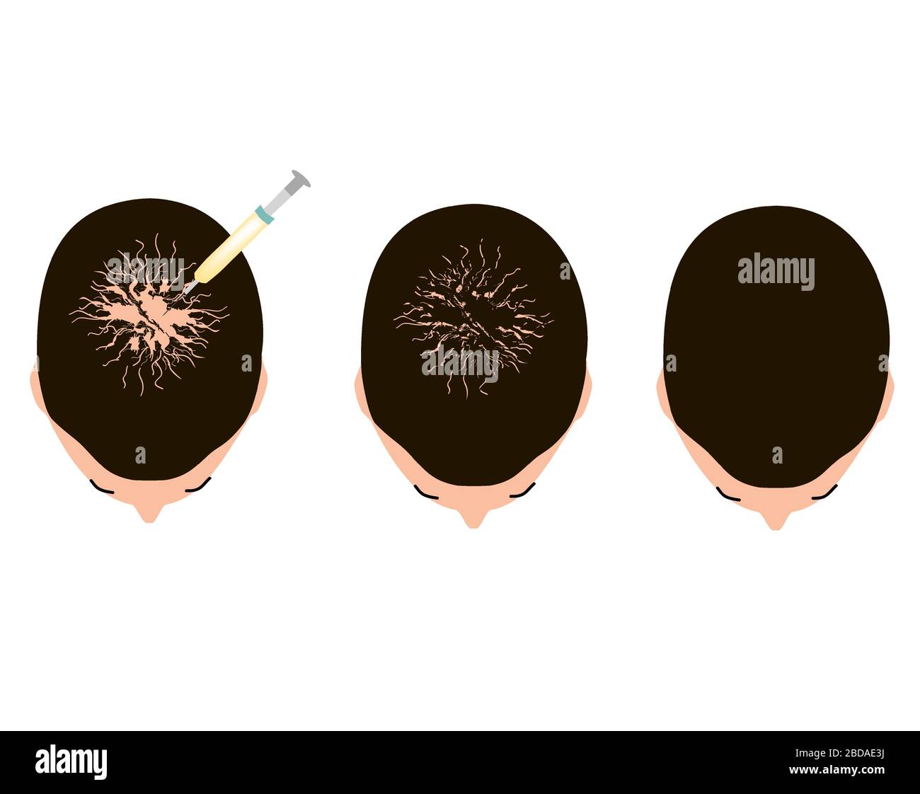 Behandlung von Alopezie. Glatze, Kahlheit, Alopecia Mesotherapie. Infografiken. Vektordarstellung auf isoliertem Hintergrund. Stock Vektor