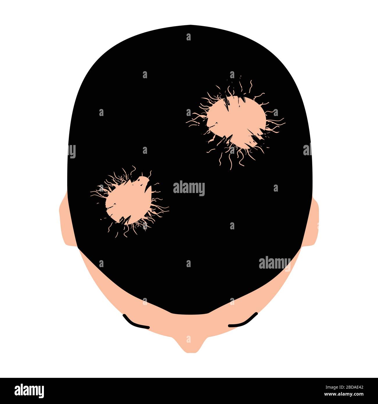 Alopezie Haar. Haarausfall am Kopf. Alopecia areata. Infografiken. Vektordarstellung auf isoliertem Hintergrund. Stock Vektor