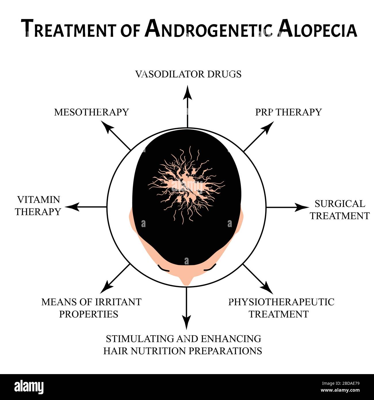 Behandlung von Alopezie. Glatze, Kahlheit, Alopecia Mesotherapie. Infografiken. Vektordarstellung auf isoliertem Hintergrund. Stock Vektor