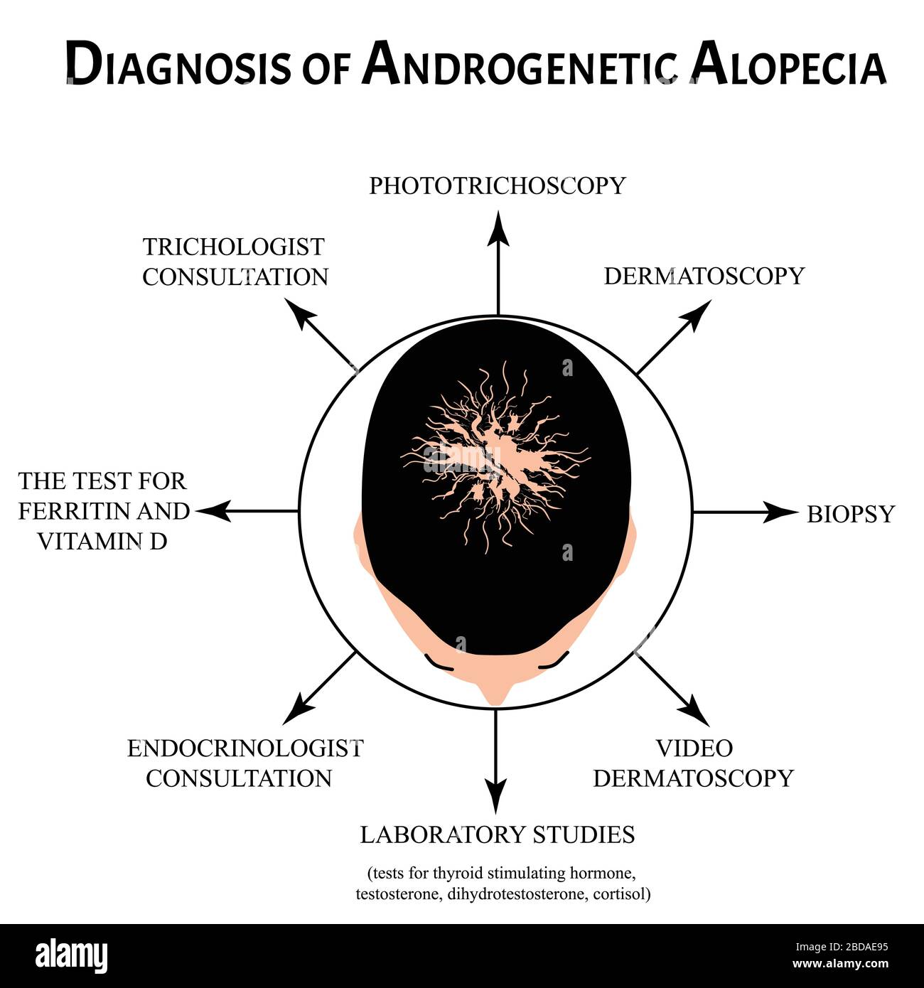 Diagnose von Alopezie. Glatze, Kahlheit, Alopecia Mesotherapie. Infografiken. Vektordarstellung auf isoliertem Hintergrund. Stock Vektor