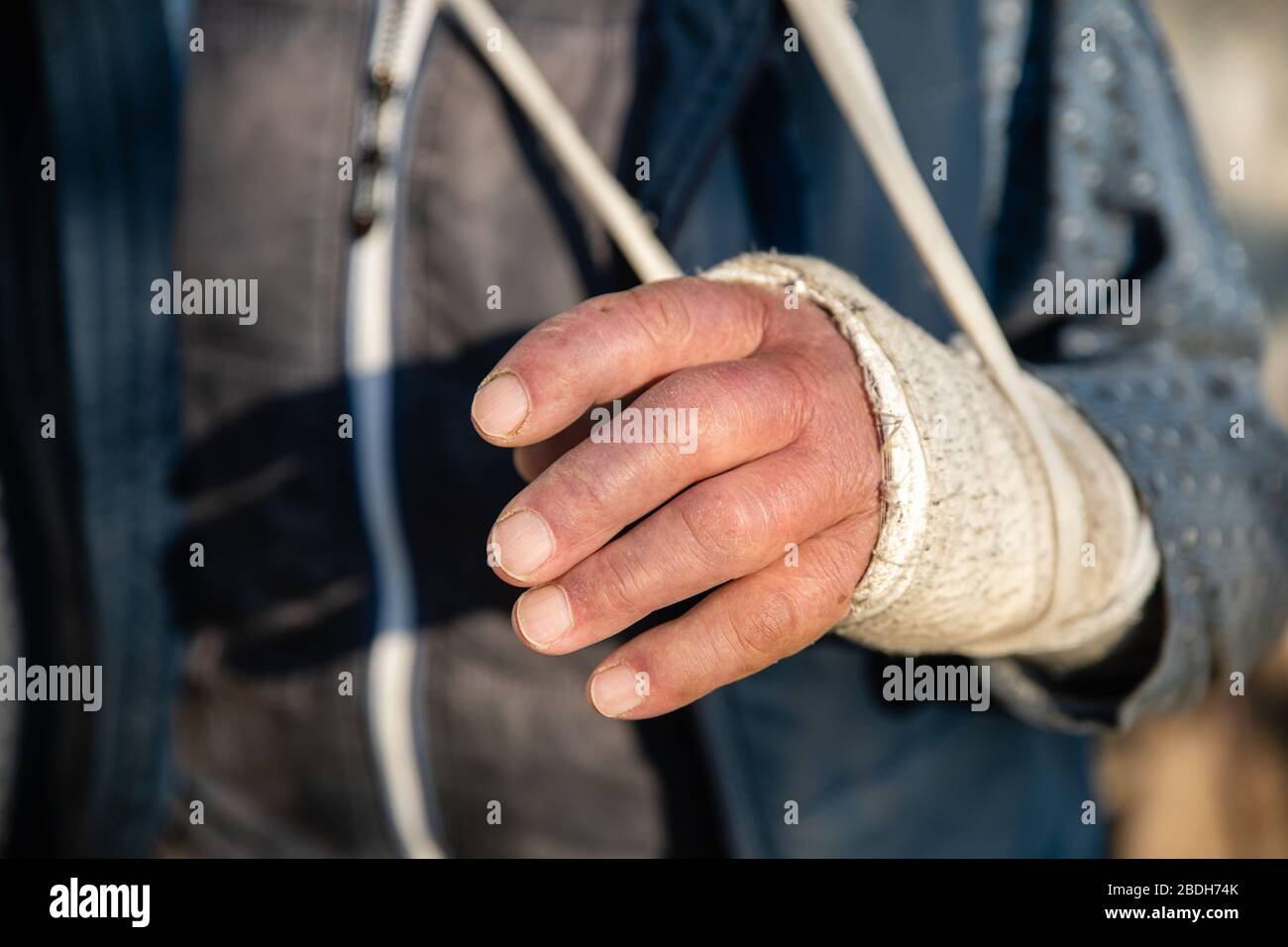 Geschwollene gebrochene Hand des alten Mannes in schmutzigen weißen Verband Stockfoto Geschwollene gebrochene Hand des alten Mannes in schmutzigen weißen Verband Stockfoto