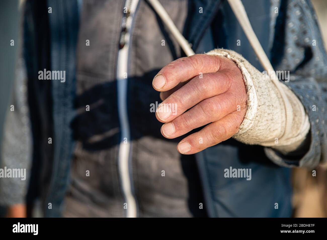 Geschwollene gebrochene Hand des alten Mannes in schmutzigen weißen Verband Stockfoto Geschwollene gebrochene Hand des alten Mannes in schmutzigen weißen Verband Stockfoto