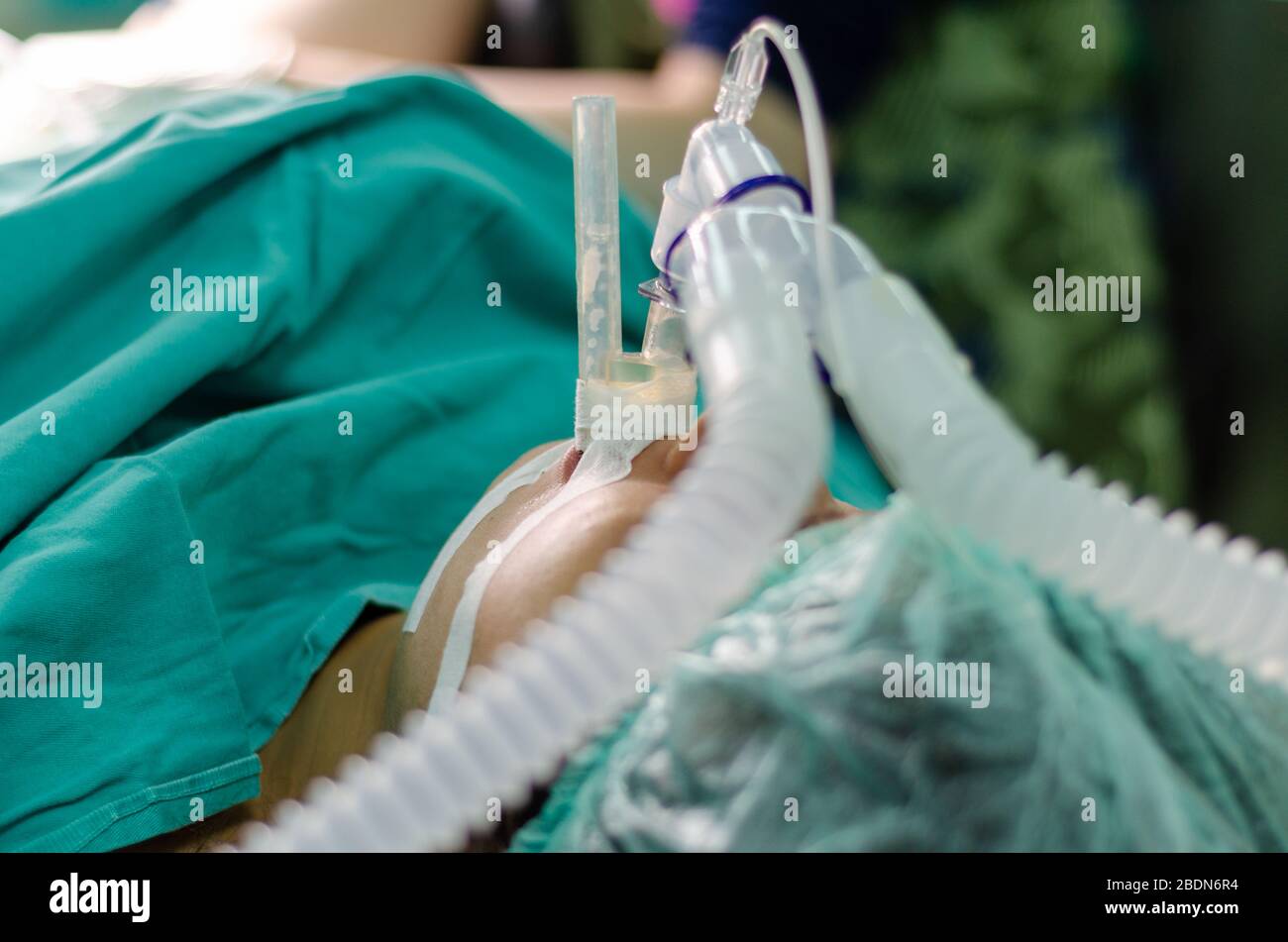Patient mit einem Endotrachealtubus im Operationssaal Stockfoto