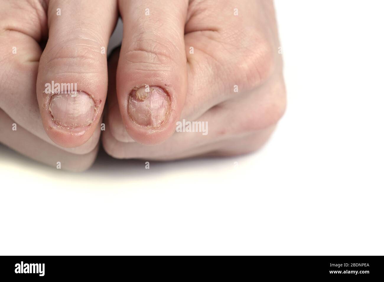 Nahaufnahme von Nagelpilz-Infektion. Pilzinfektion auf Nägel Hand, Finger  mit Onychomykose, Schäden an der menschlichen Hand Stockfotografie - Alamy