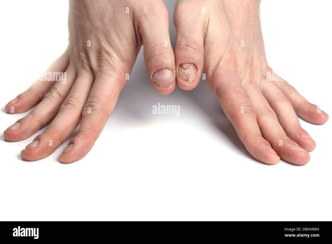 Nahaufnahme von Nagelpilz-Infektion. Pilzinfektion auf Nägel Hand, Finger mit Onychomykose, Schäden an der menschlichen Hand. Stockfoto